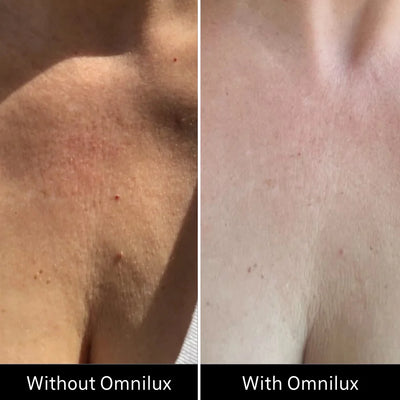 Omnilux Contour™ NECK & DÉCOLLETÉ